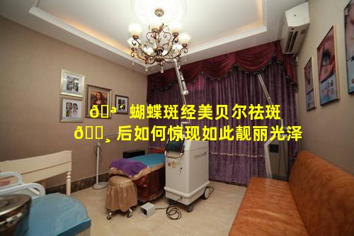 🪴 蝴蝶斑经美贝尔祛斑 🌸 后如何惊现如此靓丽光泽